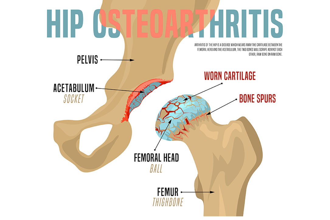 Hip Osteoarthritis Treatment Without Steroids or Surgery