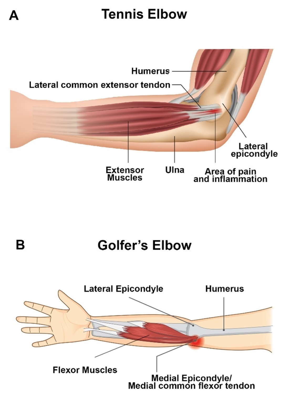 pathophysiology-of-tennis-elbow-and-golfer’s-elbow