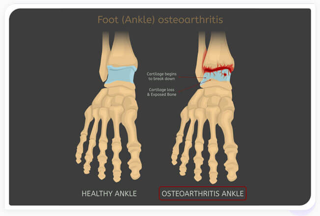 Ankle osteoarthritis