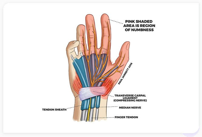 carpal tunnel syndrome