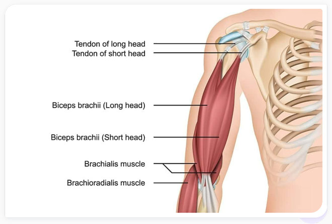 symptoms of a distal biceps tendon tear