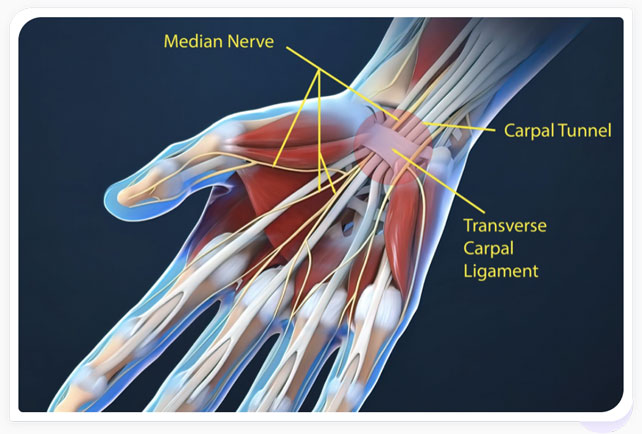 causes carpal tunnel syndrome