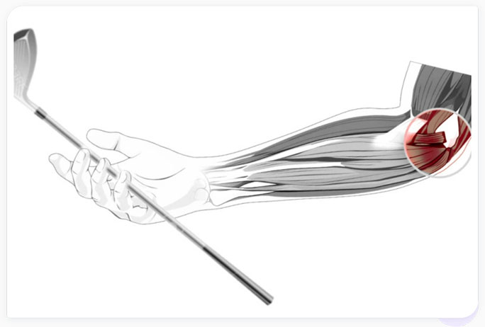 Causes Golfer's Elbow