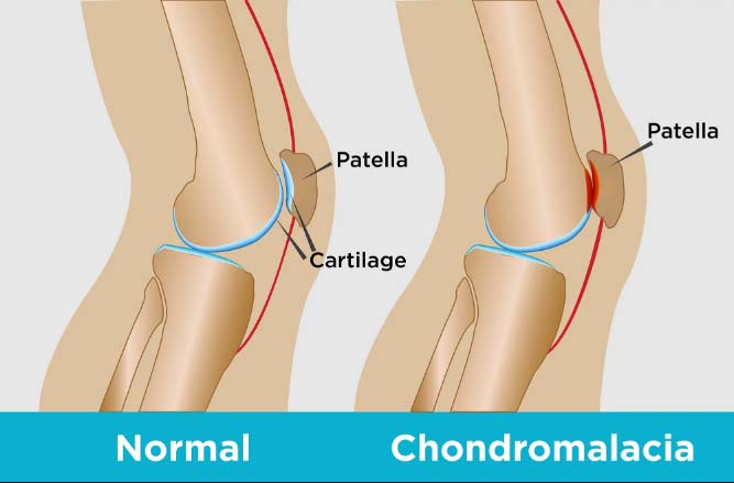 Non-Surgical Treatment for Chondromalacia Patella, Solana Beach, CA bbw 667x439 image Non-Surgical Treatment for Chondromalacia Patella, Solana Beach, CA picture