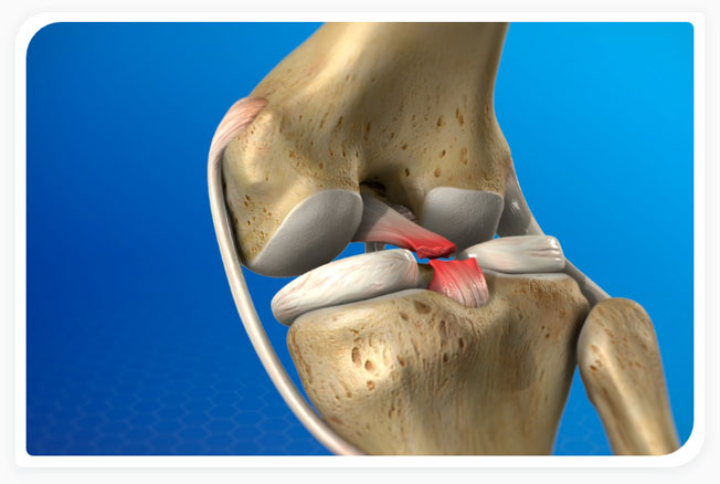 ACL/PCL and meniscus tears diagnosed
