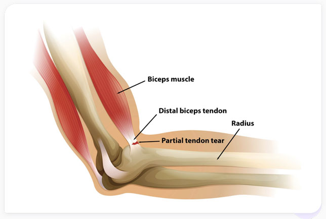 distal biceps tendon tear