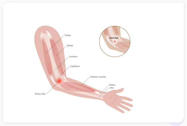 golfer elbow