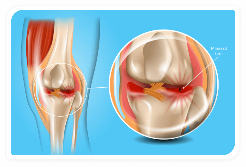 Risk Factors for Chondromalacia