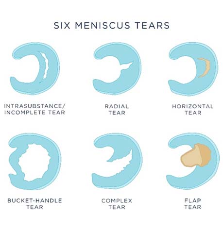 Pain Meniscus Tears