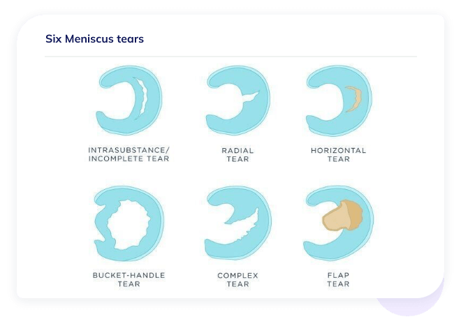 Pain Meniscus Tears