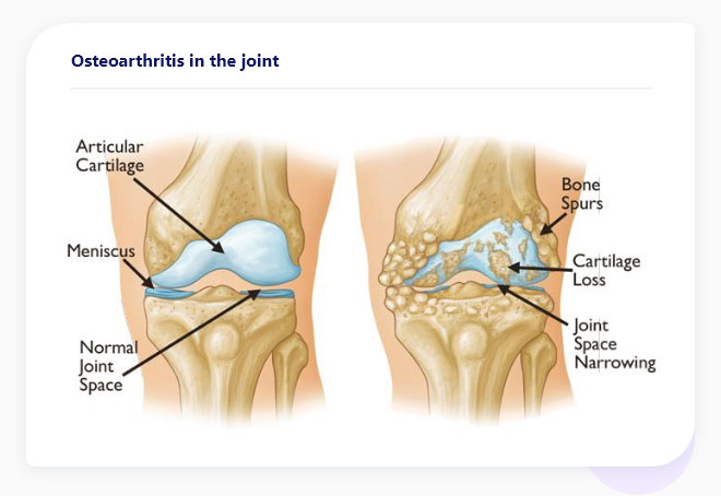 Shoulder pain