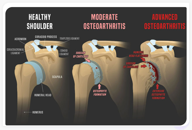 osteoarthritis