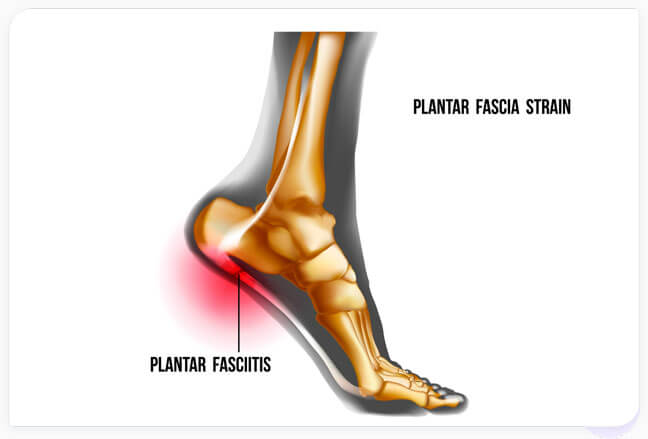 Plantar Fasciitis