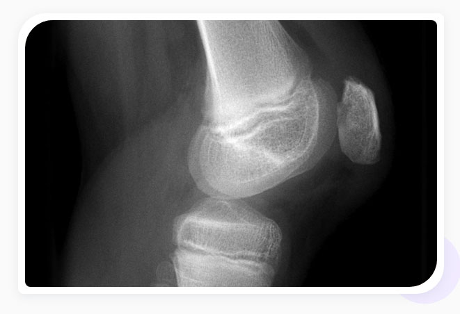 Risk Factors for Chondromalacia