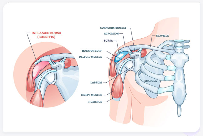 shoulder bursitis