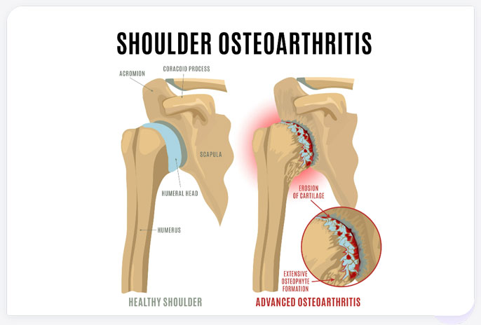 Stages of osteoarthritis