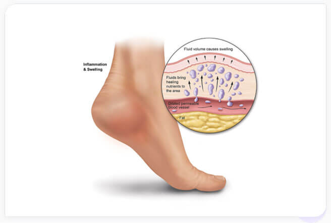 symptoms of plantar fasciitis