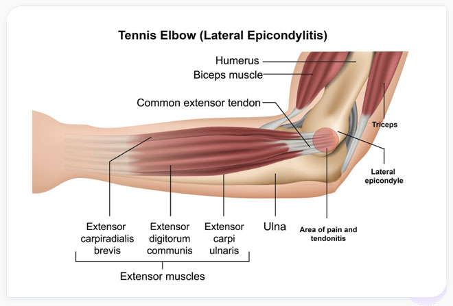 Illustration of Tennis elbow (lateral epicondylitis)
